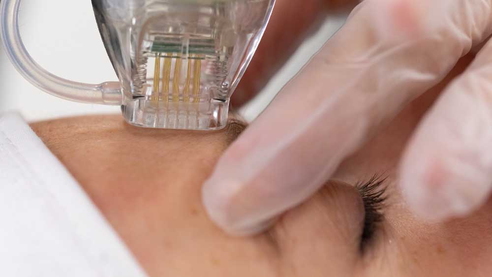 Falsificazione, marcatura CE e prodotti estetici implantabili, cosa cambia con il nuovo manuale borderline